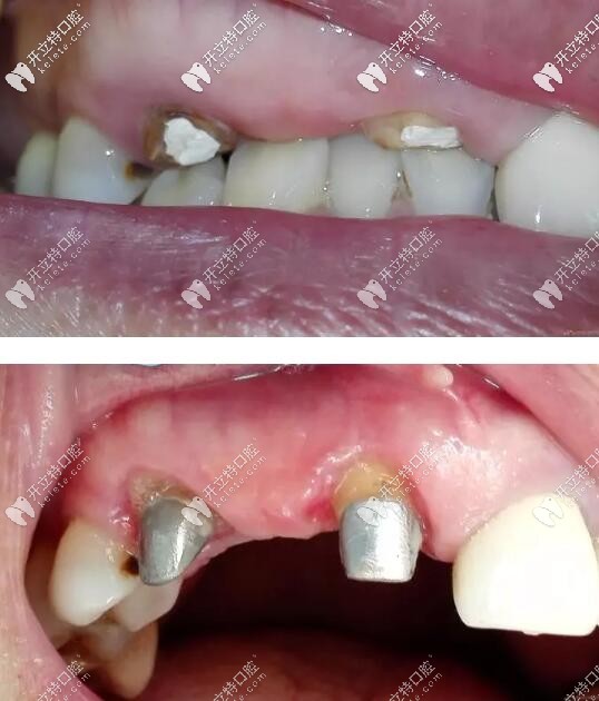 殘牙根鑲假牙案例