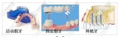 鑲牙的三種方式