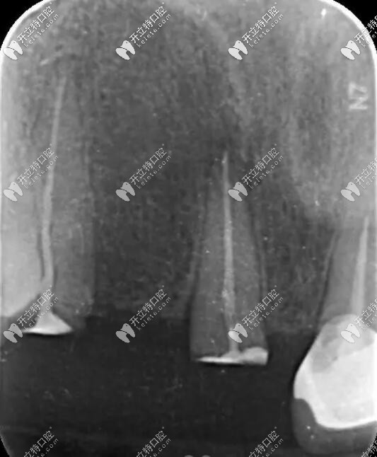 牙齒殘根需謹(jǐn)慎拔除,殘牙根上可鑲假牙防止牙槽骨萎縮哦