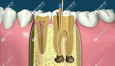 根管治療4次哪次比較痛