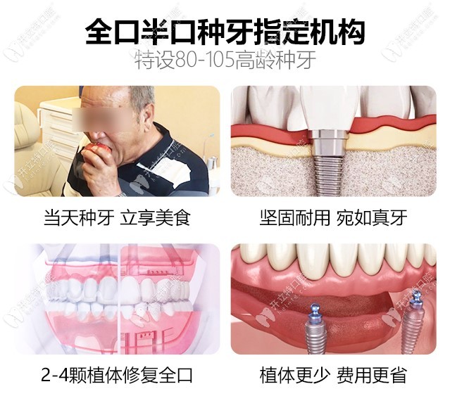 中諾是全口半口種植牙指定機構(gòu)