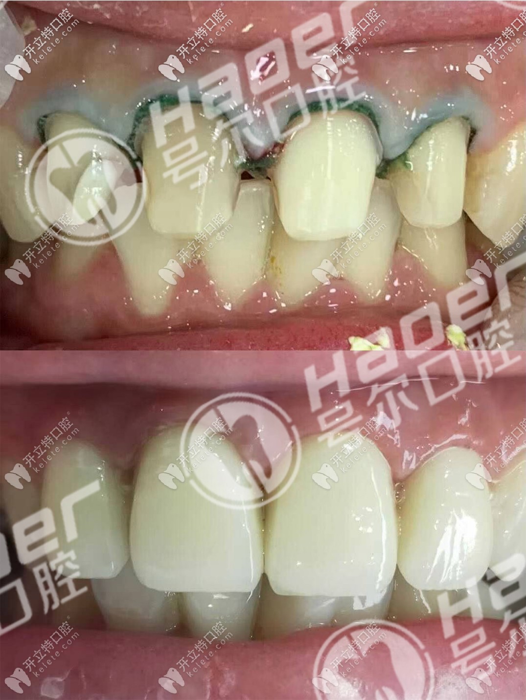 說不痛苦是假的,談?wù)勎铱敬裳烙?年后拆了換全瓷牙過程！