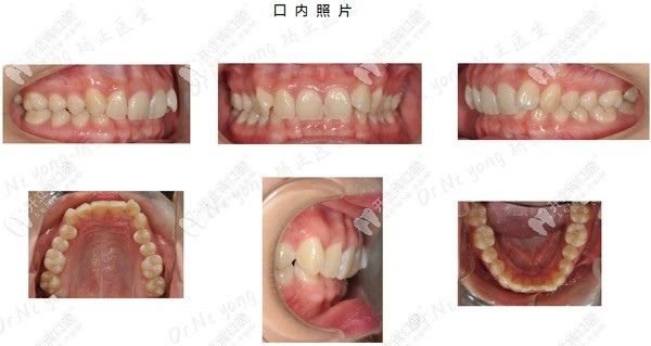 矯正前口內(nèi)的牙齒情況