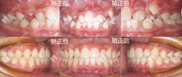 李文星兒童矯正案例一