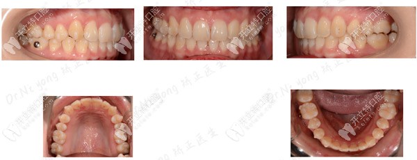 深覆合矯正后牙齒的變化圖