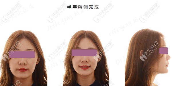 過了半年了，臉型還是有點(diǎn)變化的喲