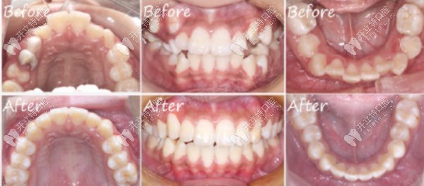 兒童門牙前突+牙列擁擠案例二