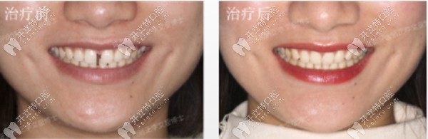 該客戶上下牙縫隙過大