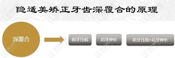 了解戴隱適美C5矯正牙齒深覆合的原理,就知道效果好不好嘍