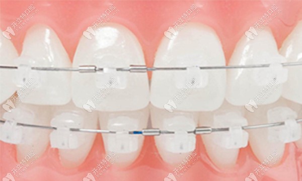 陶瓷托槽美觀性