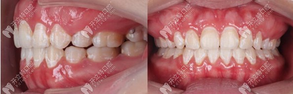 西安鼎秀齒科金屬自鎖案例 西安鼎秀齒科金屬自鎖案例