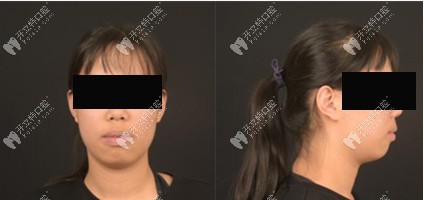 西安鼎秀齒科牙齒矯正案例 西安鼎秀齒科牙齒矯正案例