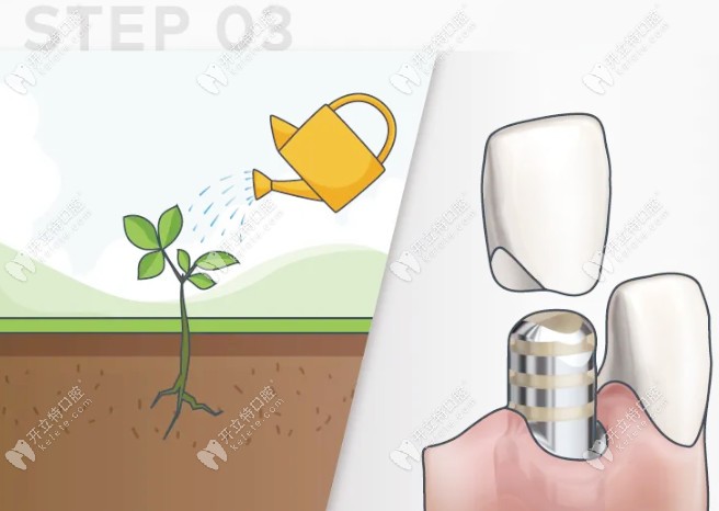種牙與種樹的過程