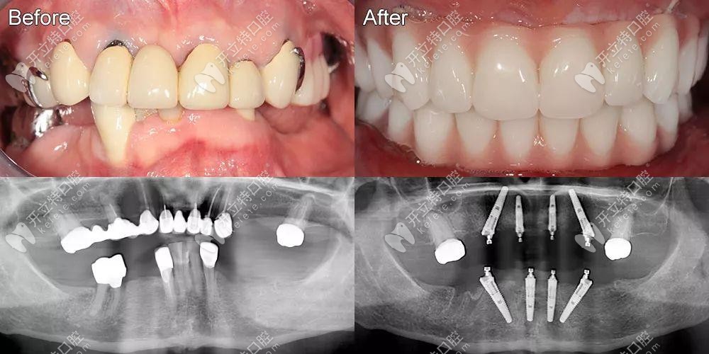 即刻負重4顆和6顆的真實區(qū)別已發(fā)放,它的優(yōu)勢是當(dāng)天戴牙冠