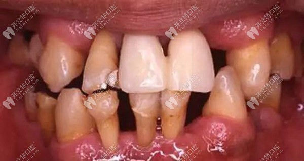 牙齦突然無(wú)緣無(wú)故出血,當(dāng)心是牙周炎在作祟！