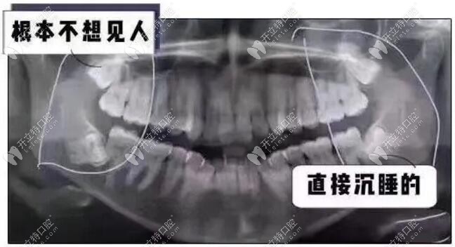 長得很對稱，4顆智齒清潔不到