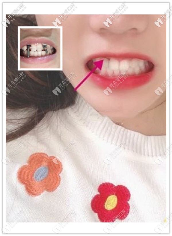 重慶美奧口腔黃澤源醫(yī)生給缺兩顆側(cè)切牙女孩用德國(guó)ICX種植體修復(fù)成功啦