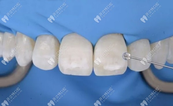 斑點(diǎn)還是存在，需要進(jìn)一步酸蝕