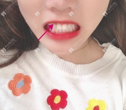 戴上牙冠的我真的很自信