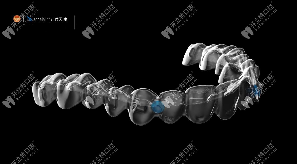 時代天使隱形牙套圖示 時代天使隱形牙套圖示