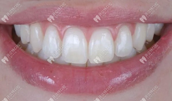 滲透樹(shù)脂治療氟斑牙的效果圖