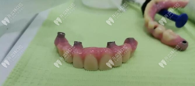 制作牙冠