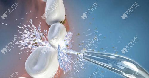 超聲波潔牙 超聲波潔牙