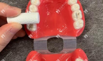 正確的咬膠放置位置——應該覆蓋整個牙面