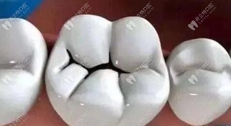 牙咬合面有黑線，輕微可補(bǔ)牙