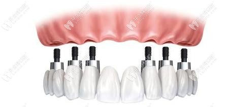 6顆種植體植入位置示意圖