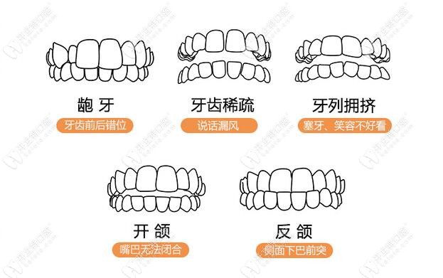 普通鋼牙套針對(duì)的癥狀