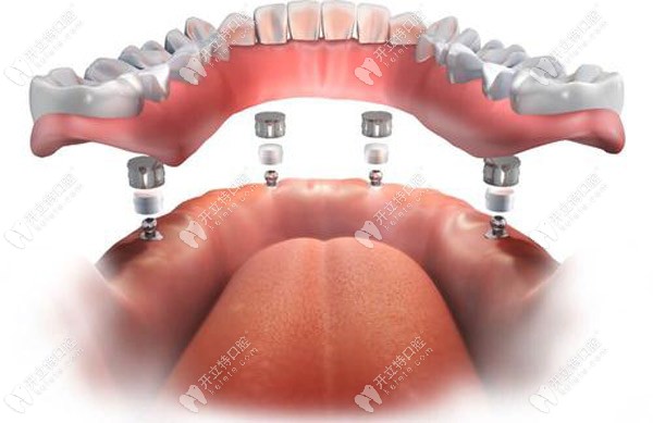 半口allon4即刻種植技術(shù)