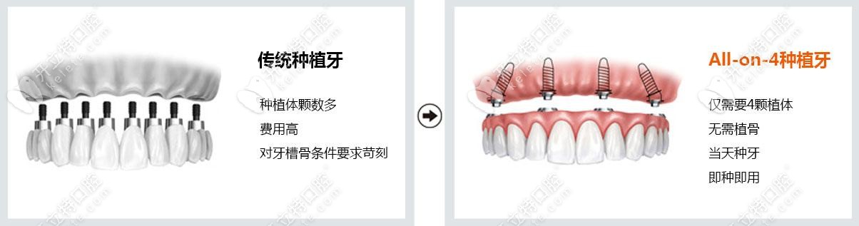 all-on-4即刻負(fù)重 all-on-4即刻負(fù)重