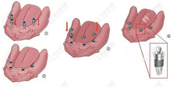 半口半固定的種植過程