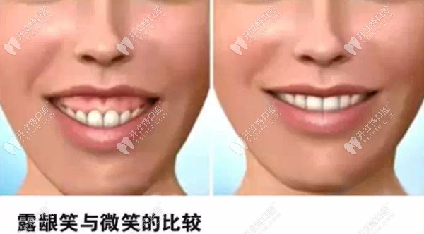 露齦笑與正常微笑的對比圖