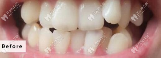 牙齒矯正前的外觀 牙齒矯正前的外觀