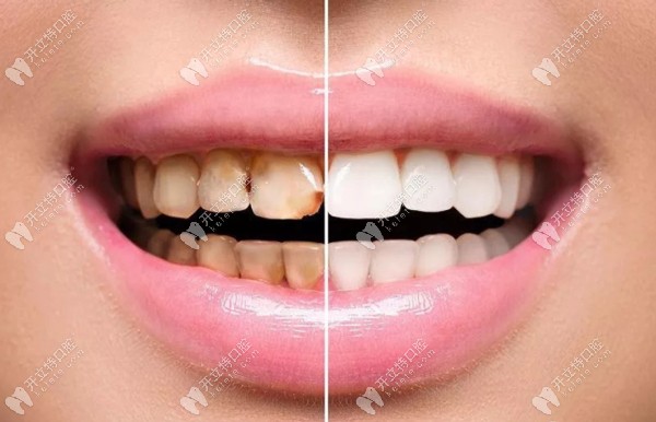 瓷優(yōu)健與瓷倍健全瓷牙哪個(gè)好