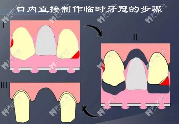 臨時牙冠口內(nèi)直接制作的步驟