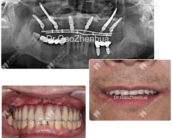 當(dāng)天做完VIIV穿顴穿翼手術(shù)