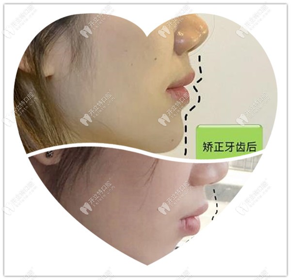 齙牙凸嘴牙齒矯正前后對(duì)比 齙牙凸嘴牙齒矯正前后對(duì)比