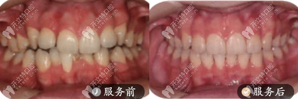 正畸案例-舌側(cè)矯正