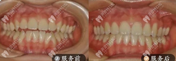 正畸案例-隱形牙套