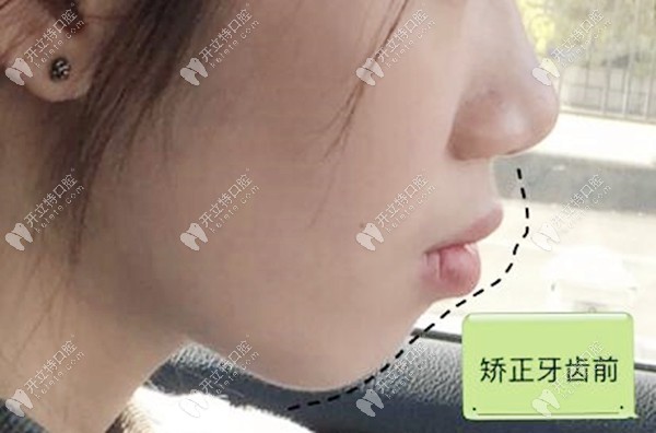 齙牙凸嘴矯正前 齙牙凸嘴矯正前