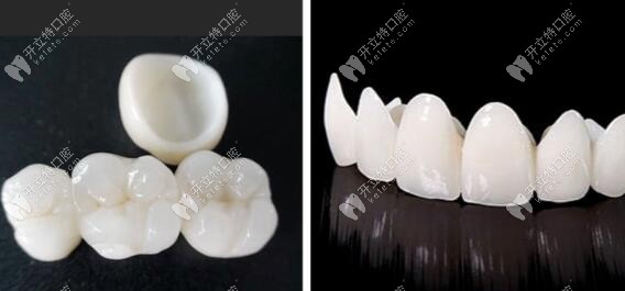 全瓷牙