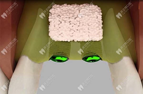 骨劈開過程中加入骨粉