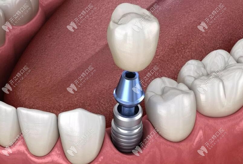 即刻種植、即刻負(fù)重技術(shù)優(yōu)勢(shì)