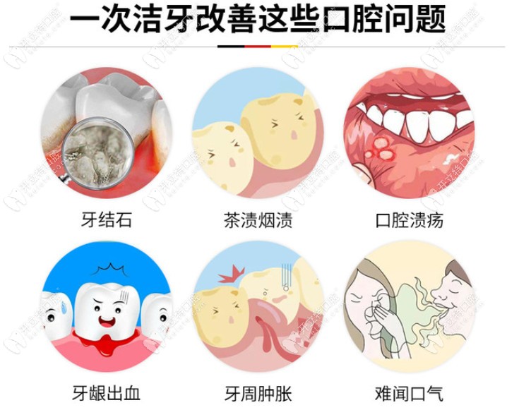 德國KAVO氣動聲波潔牙改善口腔問題