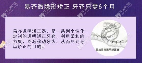 美加易齊牙套適合輕微牙齒矯正顧客
