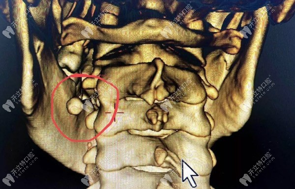 罕見的涎石癥也會引起口腔下頜腫脹、疼痛