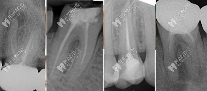 上課啦：你知道藥物中的EDTA在根管治療中起什么作用嗎？